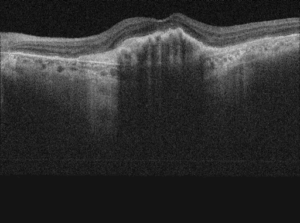 The Retina Clinic London Age Related Macular Degeneration