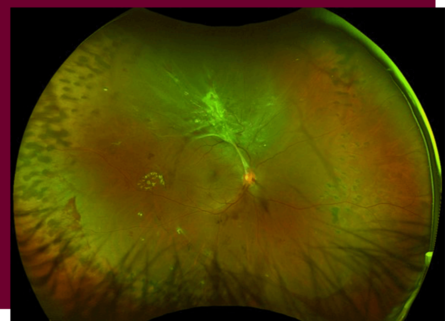 Diabetic Eye Disease The Retina Clinic 2024