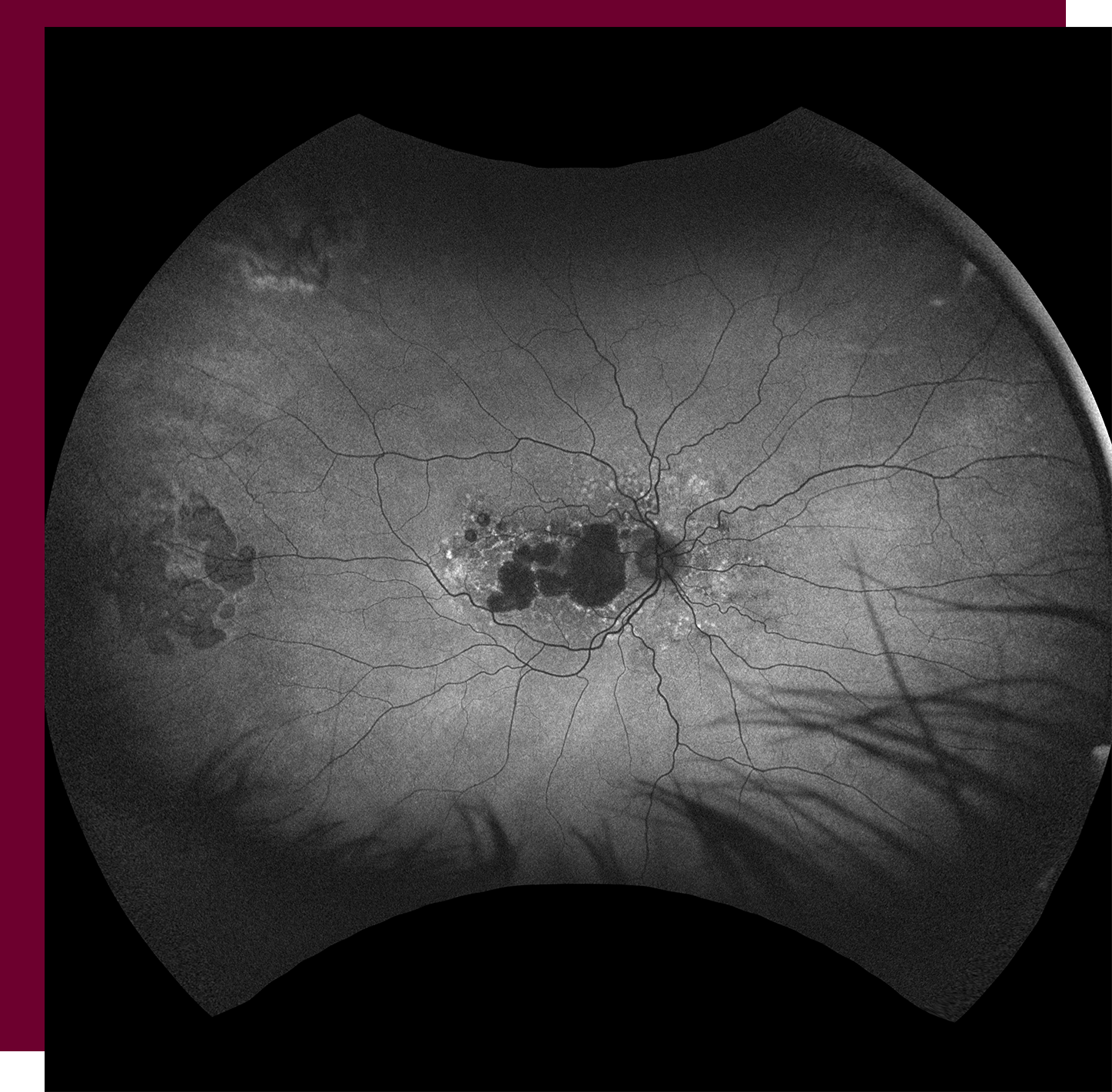 The Retina Clinic Geographic Atrophy