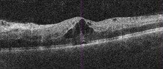 Central Retinal Vein Occlusion Macula OCT
