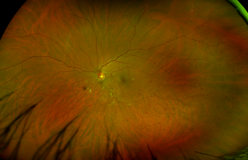 Central Retinal Vein Occlusion The Retina Clinic London