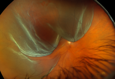 Retinal Detachment - The Retina Clinic London