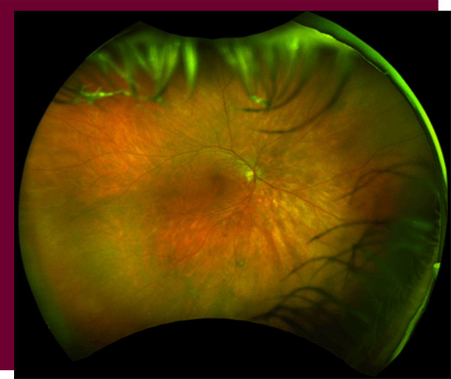 The Retina Clinic London | Birdshot Chorioretinopathy