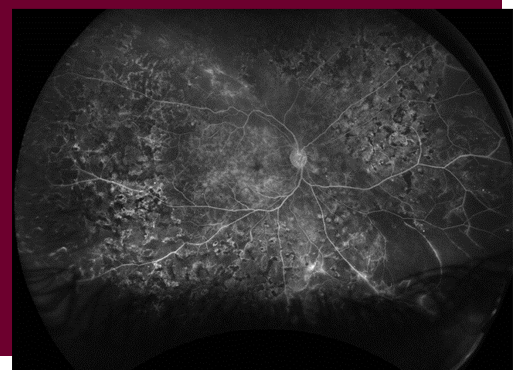 Diabetic Eye Disease The Retina Clinic London